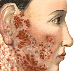 Scrofula